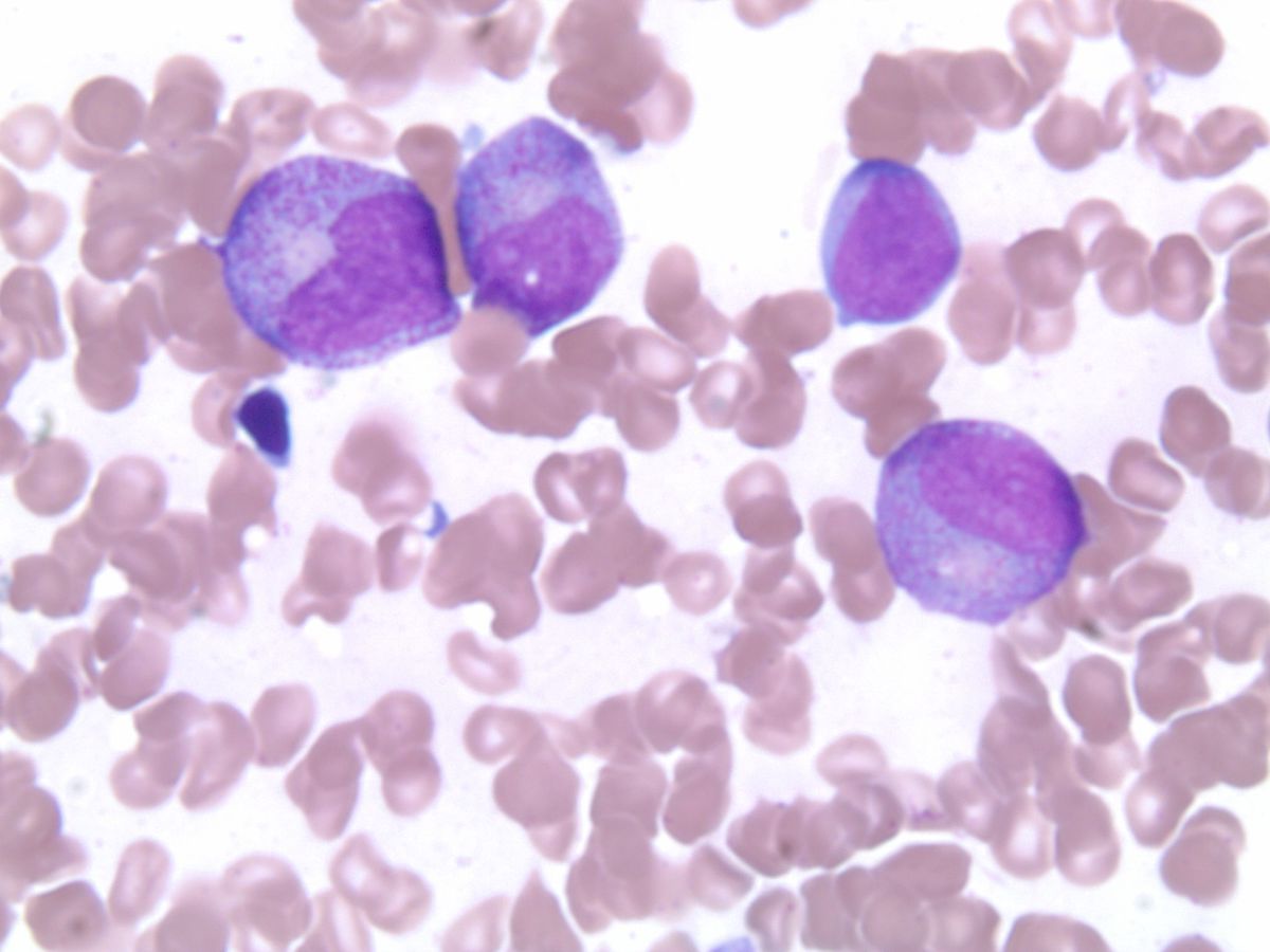 Day 22 bone marrow aspirate #2
